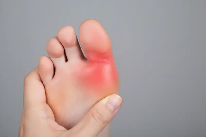 Etwa 35 Prozent aller medikamentös bedingten Gichtanfälle stehen im Zusammenhang mit Diuretika oder niedrig dosiertem Aspirin